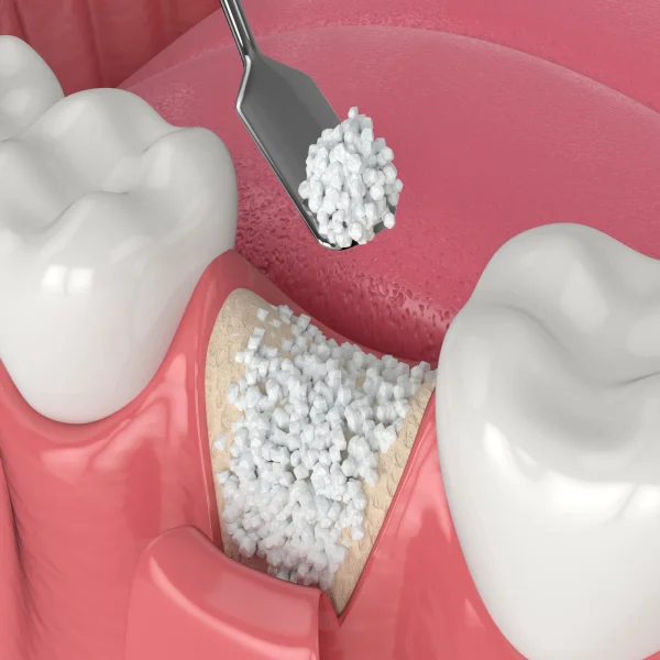 Ghép xương có đau không? Bao lâu thì lành để trồng răng Implant?