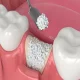 Ghép xương có đau không? Bao lâu thì lành để trồng răng Implant?